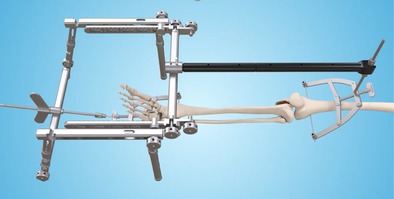 Equilibrium Mechanics in Fracture Reduction of Tibial Plateau.