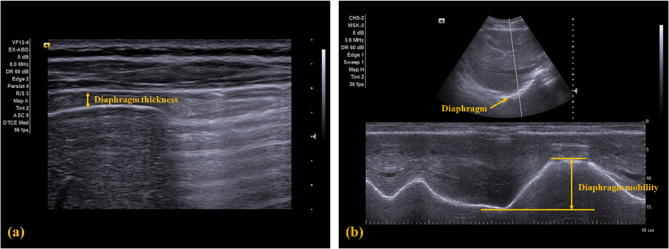Effects of manual diaphragm release on pain, disability and diaphragm function in patients with chronic neck pain: a pilot randomized controlled trial.