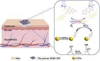 A Porous SERS Microneedle for Multiplex Detection of Glucose, Uric Acid, and Cholesterol in Interstitial Fluid
