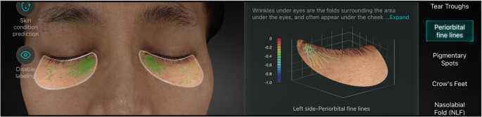 Nonsurgical lower eyelid rejuvenation using a novel 1064-nm Nd:YAG laser with a 650- microsecond pulse duration.
