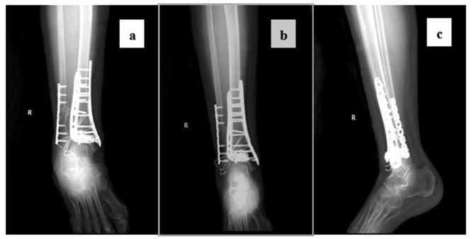The Influence of Preoperative Central Sensitization on the Postoperative Prognosis of Pilon Fractures: A Retrospective Study.