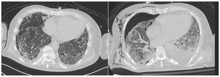 The Predictive Power of Barotrauma from the Macklin Effect in the ARDS Population: A Comparison of COVID-19 and Non-COVID-19 ARDS-Could the Macklin Effect Serve as a Helpful Tool for Evaluating Transfer to ARDS Reference Centers?