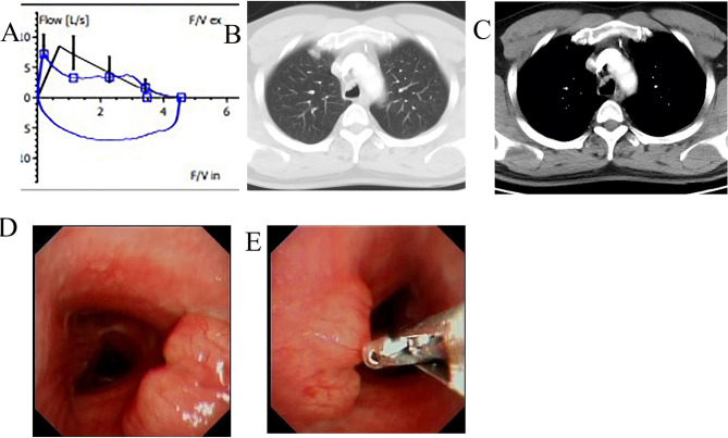 Severe central airway obstruction caused by primary endobronchial B-cell lymphoma: three case reports and literature review.