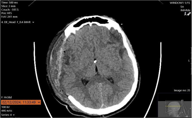 Electric scooter related injuries among children: a single institutional experience.
