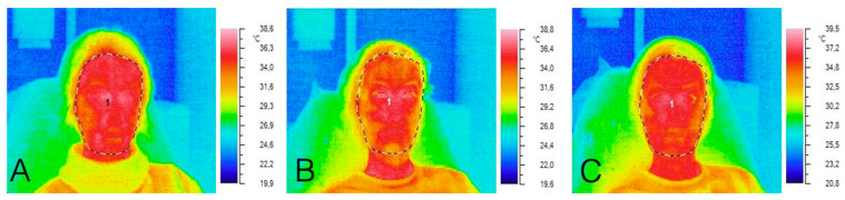 Evaluation of the Effectiveness of Botulinum Therapy Based on the Anthropometric Characteristics of the Face Using Non-Invasive Thermal Imaging Data.