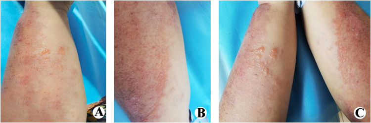 A Rare Case Report of Dermatomyositis Accompanied by Blisters.
