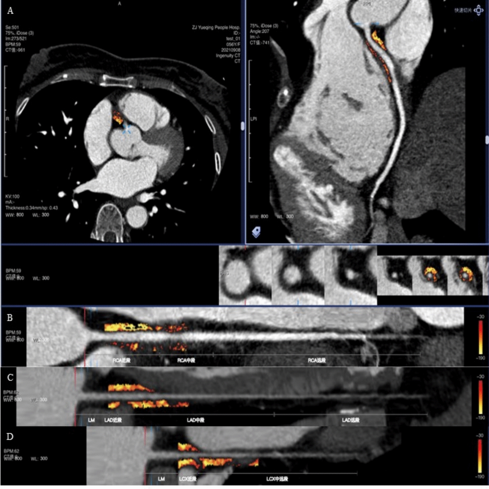 Machine learning-based integration of pericoronary adipose tissue and clinical risk factors for cardiovascular risk prediction in type 2 diabetes: a retrospective cohort study.
