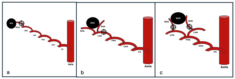 Selective Angiographic Roadmap Analysis (SARA) of Hepatocellular Carcinoma Feeding Arteries for Transarterial Chemoembolization.