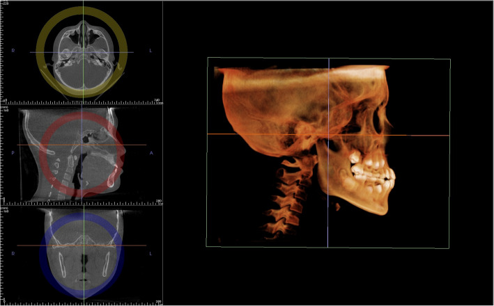 Reliability and reproducibility of CBCT assessment of craniomaxillary changes before and after treatment for Class III growing patients - a cautious or critical approach.