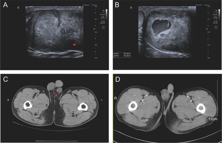 Clinicopathological characteristics and molecular genetic analysis of inflammatory and nested testicular sex cord tumor: a case report and literature review.