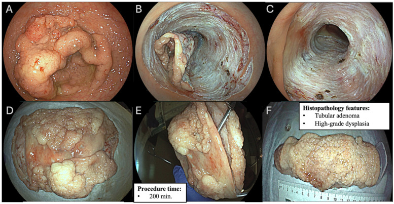 Outcomes of Endoscopic Resection of Circumferential Colorectal Laterally Spreading Lesions: A Western Experience.