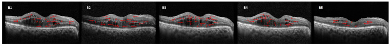 Hyperreflective Dots on SD-OCT: Implications for Predicting Treatment Outcomes in Diabetic Macular Edema.