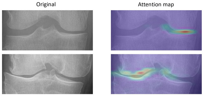 Simplifying Knee OA Prognosis: A Deep Learning Approach Using Radiographs and Minimal Clinical Inputs.