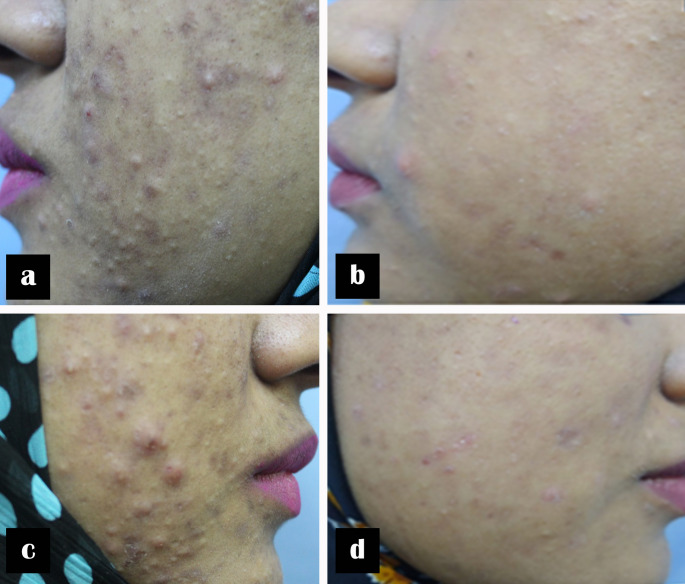 Comparative efficacy and safety of 577-nm diode laser versus 1064-nm Nd: YAG laser for inflammatory acne vulgaris: a split-face randomized study.