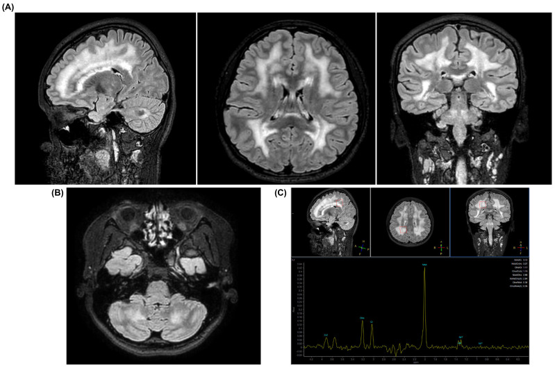 Expansion of the Phenotypic Spectrum of MNGIE: Lipodystrophy and Metabolic Alterations Associated with a p.Arg393_Val400dup TYMP Variant.