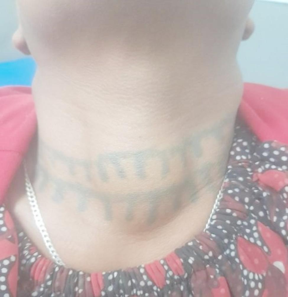 Right thyroid hemiagenesis presenting with a contralateral simple diffuse goiter: case report.