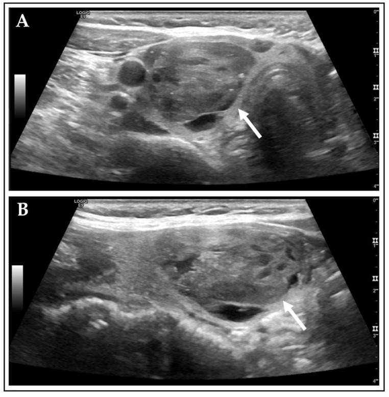 Ultrasound Risk Stratification of Autonomously Functioning Thyroid Nodules: Cine Loop Video Sequences Versus Static Image Captures.