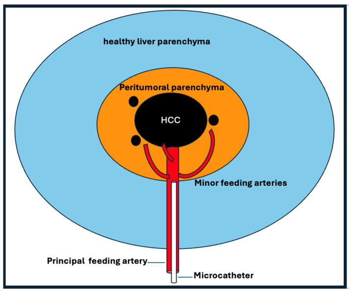 Selective Angiographic Roadmap Analysis (SARA) of Hepatocellular Carcinoma Feeding Arteries for Transarterial Chemoembolization.