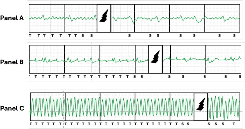 Question: Three thunderclaps in a quiescent myocardium.