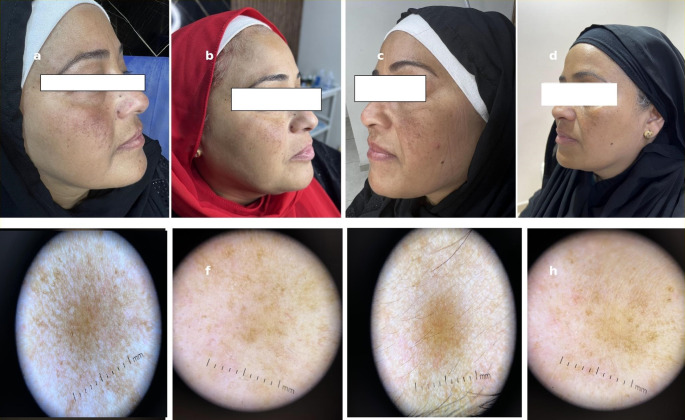 Fractional non ablative 675 nm diode laser versus low fluence high frequency Q- switched 1064 nm nd: YAG laser in the treatment of melasma: a comparative split face trial.