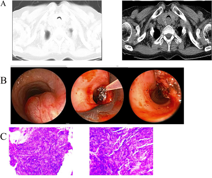 Severe central airway obstruction caused by primary endobronchial B-cell lymphoma: three case reports and literature review.