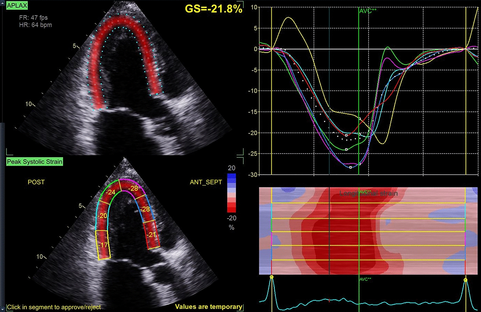 Comparative impact of persistent and paroxysmal atrial fibrillation on myocardial strain: a retrospective cohort study.
