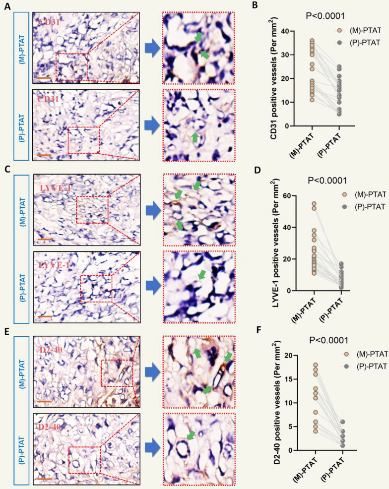 Ang-2 modulates VEGFR3-induced lymphangiogenesis in peritumoral adipose tissue of metastatic head and neck cancer.