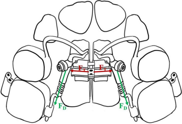 Optimizing orthodontic treatment for delayed eruption of permanent anterior teeth: A prospective study using a modified appliance.