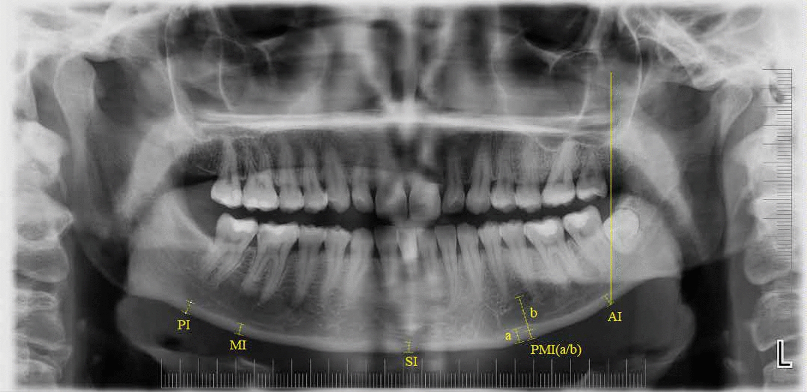 Evaluation of 3-year changes in panoramic radiomorphometric indices and fractal dimension values in primary hyperparathyroidism patients.
