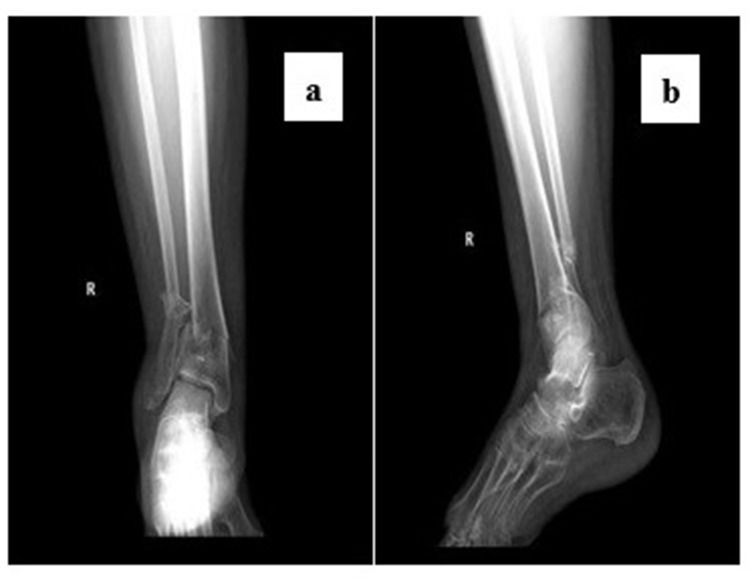 The Influence of Preoperative Central Sensitization on the Postoperative Prognosis of Pilon Fractures: A Retrospective Study.