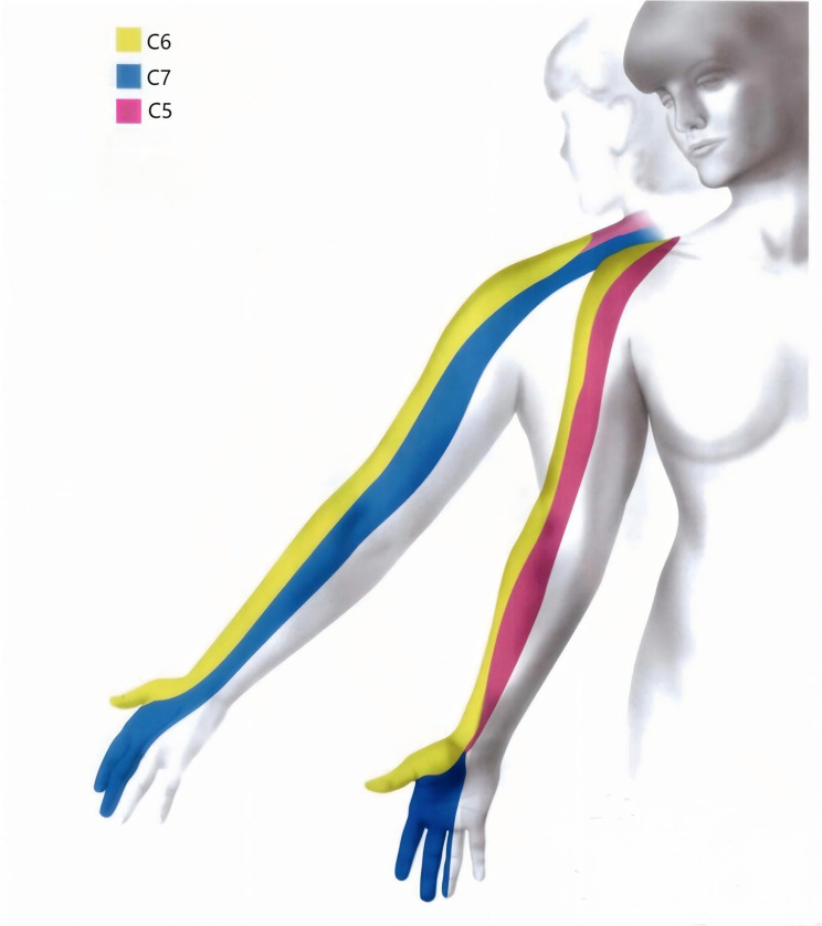 Effect of Intravenous Esketamine on Rebound Pain Following Single-Shot Brachial Plexus Block in Patients Undergoing Shoulder Arthroscopic Surgery: A Prospective, Randomized, Placebo-Controlled Study.