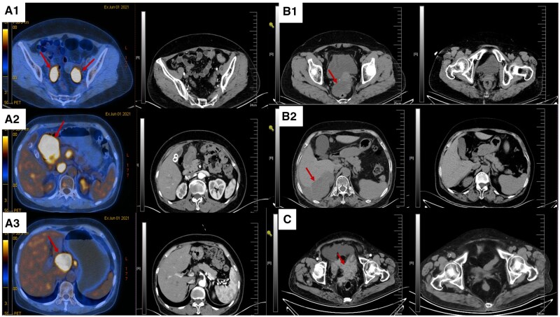 Retrospective study of elderly patients with advanced ovarian cancer who did not undergo surgery.