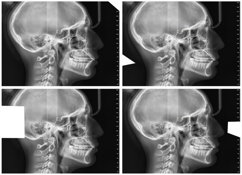 Reproducibility of AI in Cephalometric Landmark Detection: A Preliminary Study.