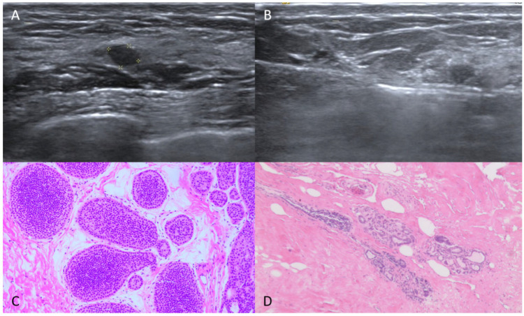 Factors Correlated with Post-Surgery Residual Carcinoma in Cases of Breast Cancer Incidentally Found via Vacuum-Assisted Excision: An Ultrasound Perspective.