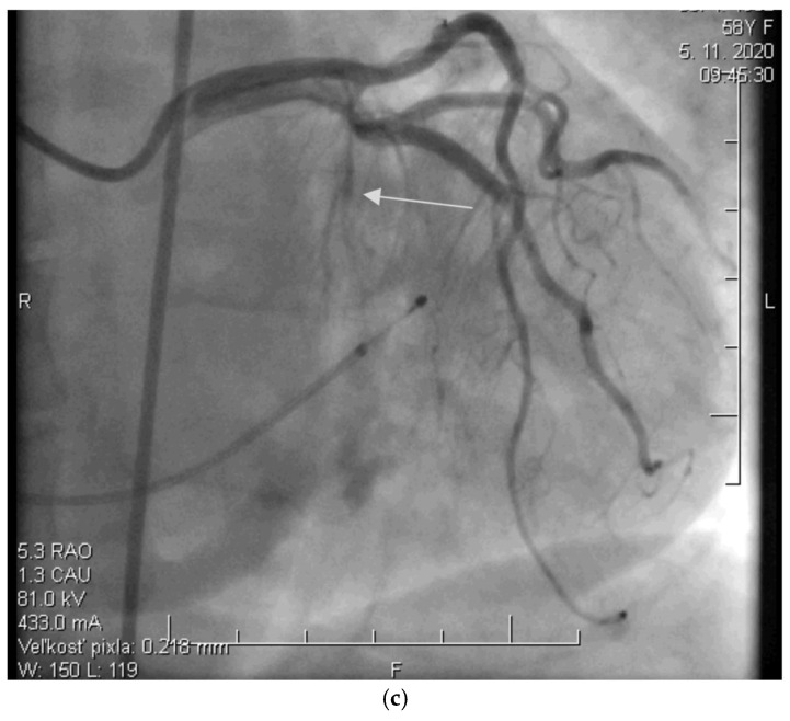 Significance of the Monitoring Right Ventricular Echocardiographic Parameters in Patients with Hypertrophic Cardiomyopathy Undergoing Alcohol Septal Ablation-A Single-Center Experience.