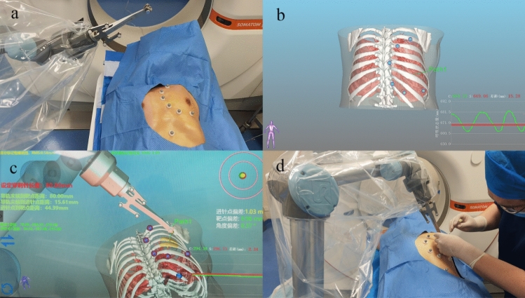 Preliminary clinical experience with a robot-assisted system in preoperative hookwire localization of pulmonary nodules: a prospective pilot study.