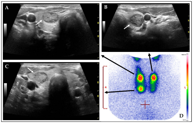 Ultrasound Risk Stratification of Autonomously Functioning Thyroid Nodules: Cine Loop Video Sequences Versus Static Image Captures.