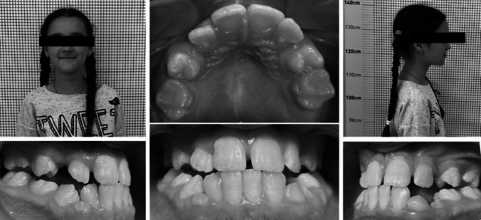 Optimizing orthodontic treatment for delayed eruption of permanent anterior teeth: A prospective study using a modified appliance.