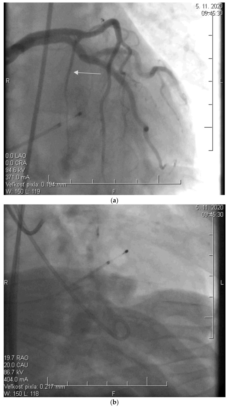 Significance of the Monitoring Right Ventricular Echocardiographic Parameters in Patients with Hypertrophic Cardiomyopathy Undergoing Alcohol Septal Ablation-A Single-Center Experience.