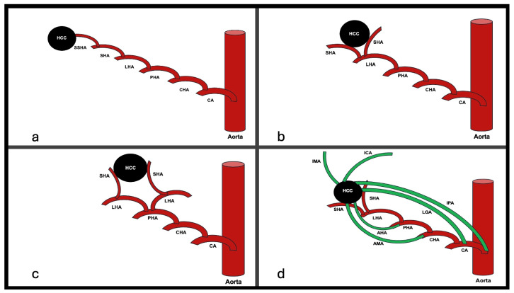 Selective Angiographic Roadmap Analysis (SARA) of Hepatocellular Carcinoma Feeding Arteries for Transarterial Chemoembolization.