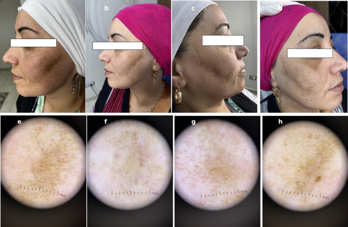 Fractional non ablative 675 nm diode laser versus low fluence high frequency Q- switched 1064 nm nd: YAG laser in the treatment of melasma: a comparative split face trial.
