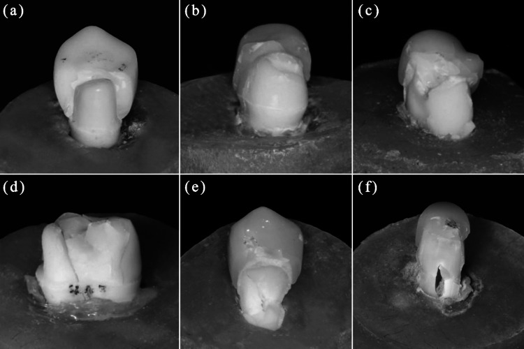 Post fatigue fracture resistance of lithium disilicate and zirconia crowns: vertical versus horizontal preparations (an in vitro study).