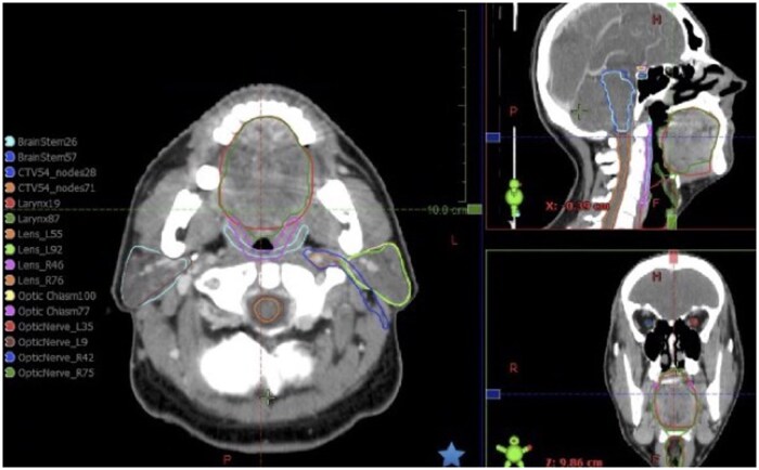 Real-world performance evaluation of commercial autocontouring software for head and neck cancer radiotherapy.