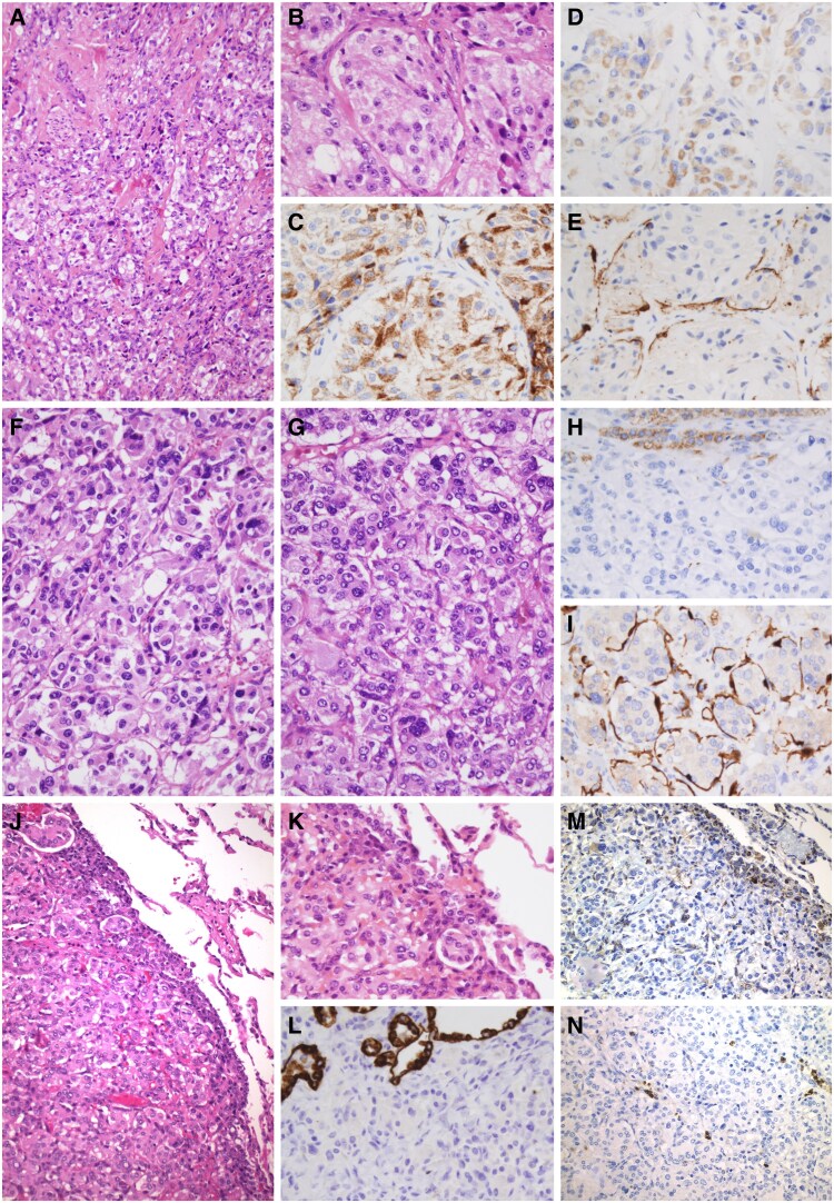 New Insights into the Clinical Characterization of SDHAF2-related Familial Paraganglioma Syndrome.