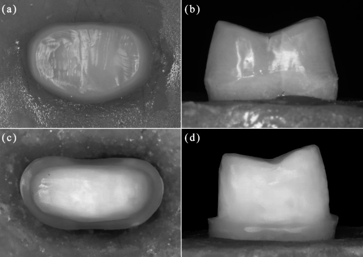 Post fatigue fracture resistance of lithium disilicate and zirconia crowns: vertical versus horizontal preparations (an in vitro study).
