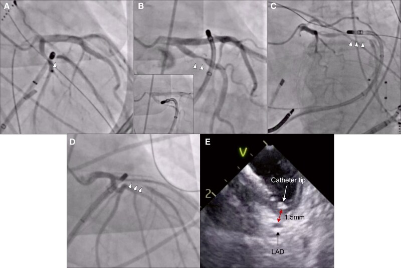 Coronary vasospasm during pulsed field focal ventricular ablation with solid tip catheter.
