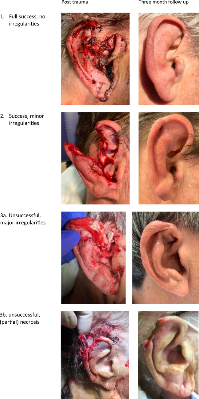 Surgical outcome following primary closure of auricular lacerations.