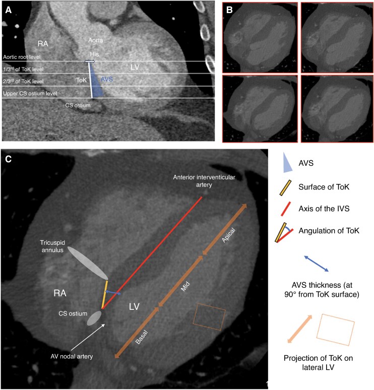 Redefining the anatomy of the triangle of Koch for the implantation of a dual-chamber single-capsule leadless pacemaker.