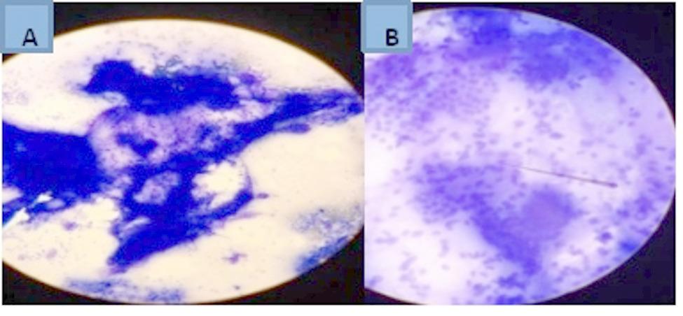 Right thyroid hemiagenesis presenting with a contralateral simple diffuse goiter: case report.