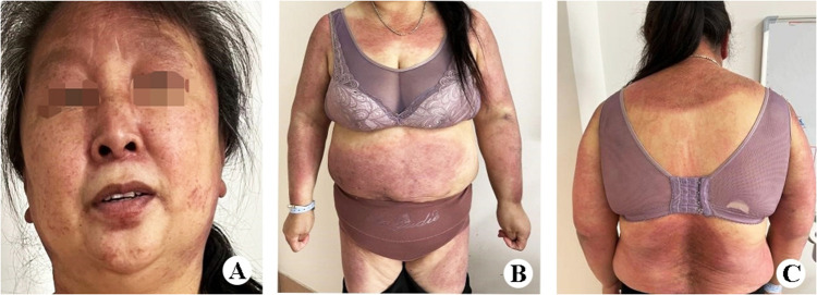 A Rare Case Report of Dermatomyositis Accompanied by Blisters.